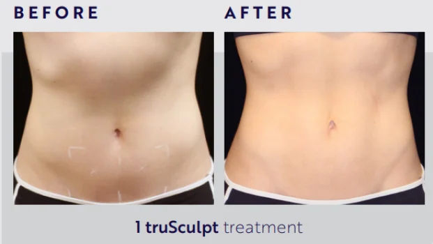 Body Contouring and Body Sculpting Before After2 at Pacific Obstetrics and Gynecology