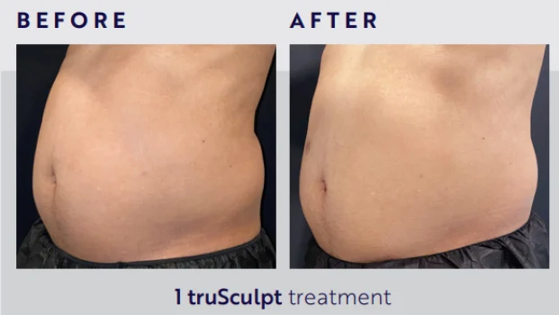 Body Contouring and Body Sculpting Before After3 at Pacific Obstetrics and Gynecology