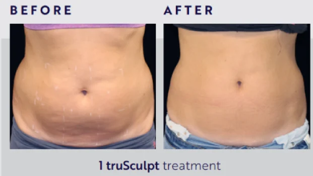 Body Contouring and Body Sculpting Before After4 at Pacific Obstetrics and Gynecology