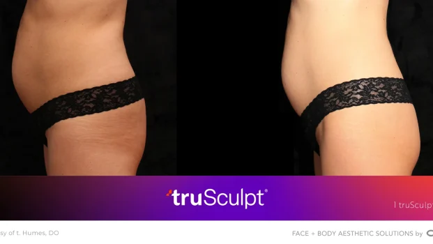 Body Contouring Before After5 at Pacific Obstetrics and Gynecology in Newport Beach, CA