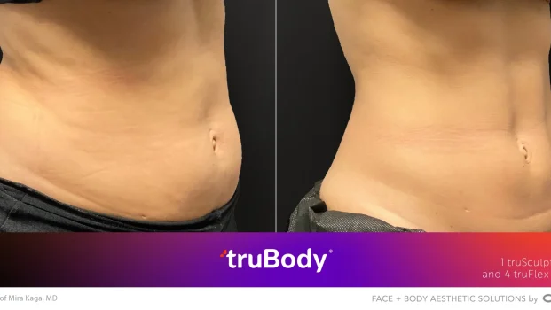 Body Contouring Before After4 at Pacific Obstetrics and Gynecology in Newport Beach, CA