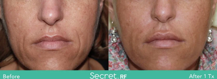 Secret RF Before and After in Newport Beach, CA | Pacific Obstetrics and Gynecology