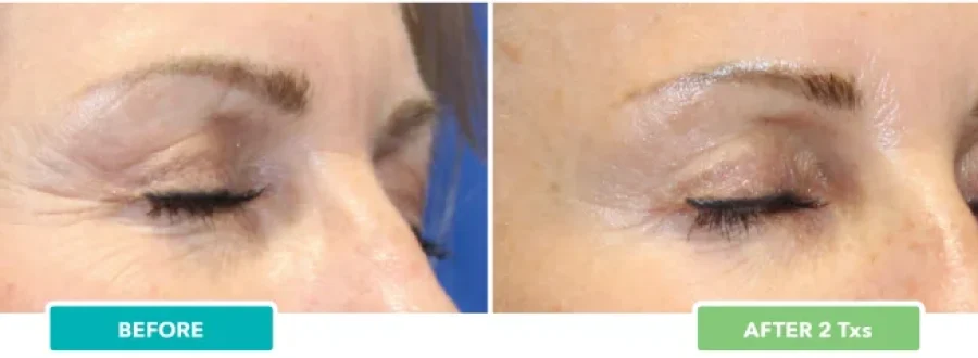 RF Micro Treatment Before After at Pacific Obstetrics and Gynecology