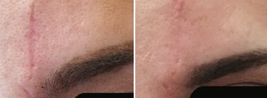 RF Micro Treatment Before After3 at Pacific Obstetrics and Gynecology