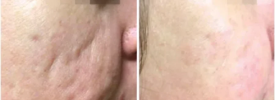 RF Micro Treatment Before After5 at Pacific Obstetrics and Gynecology