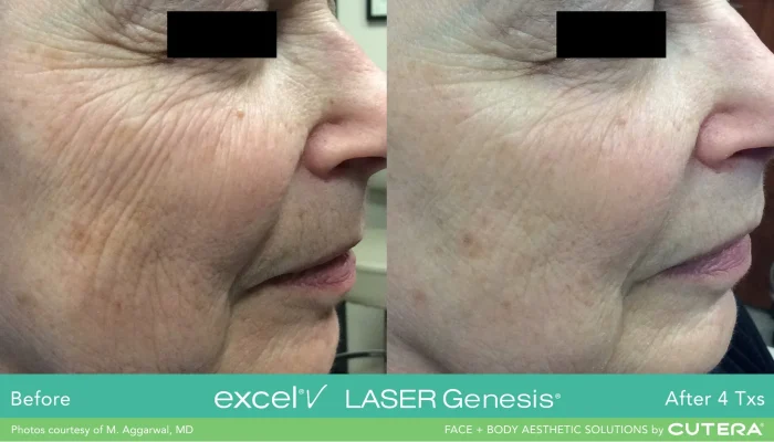 Laser Genesis Before and After in Newport Beach, CA | Pacific Obstetrics and Gynecology